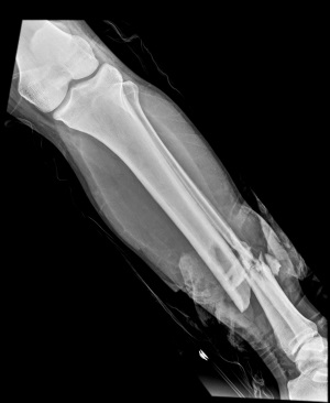pics of broken legs