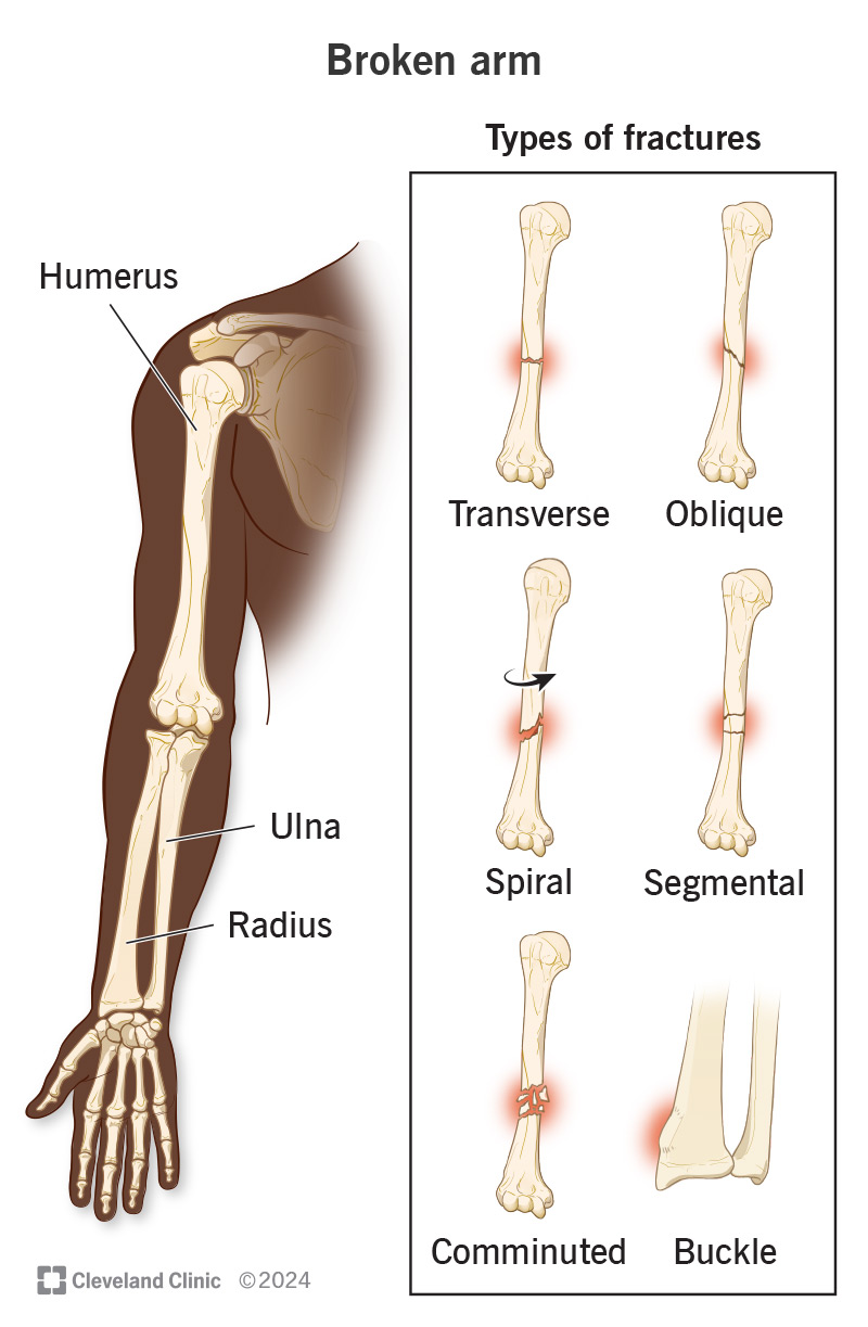 pictures of broken arm