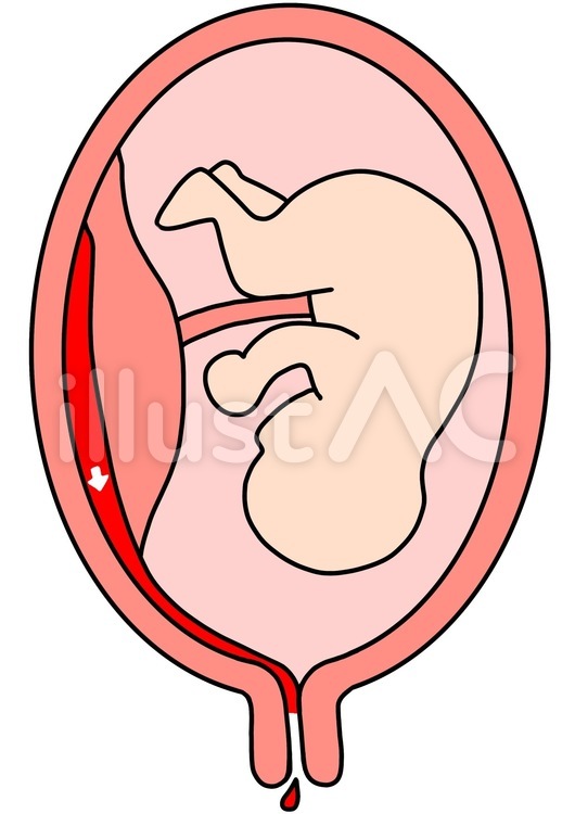 Free Vectors | Placental abruptio placentae external bleeding color