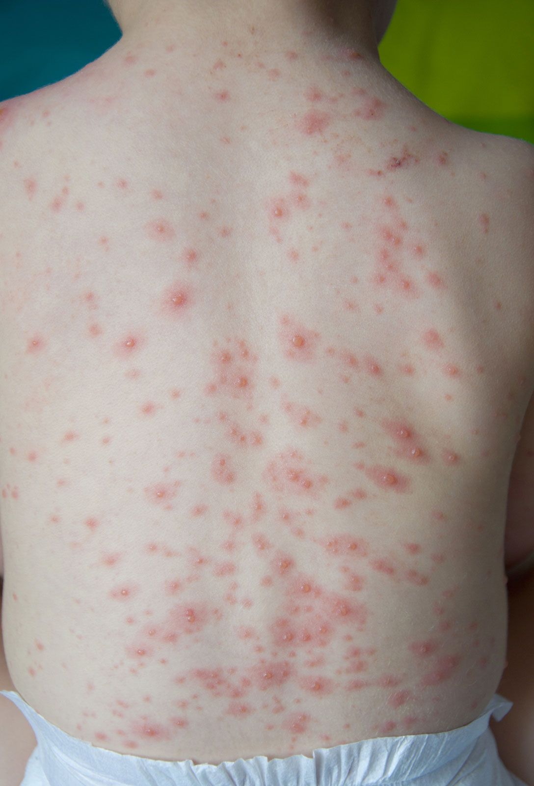 Chickenpox | Description, Cause, &amp; Symptoms | Britannica