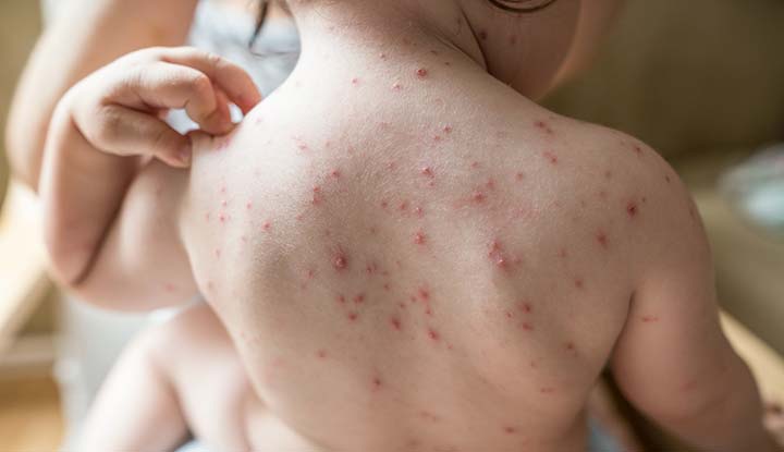 Chickenpox: Causes, Symptoms, Treatment &amp; Prevention