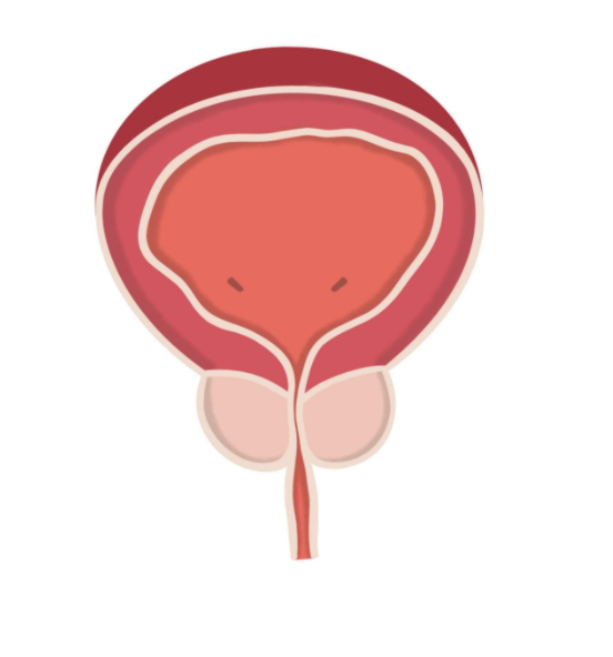 Benign Prostatic Hyperplasia - Centro de Urología Avanzada