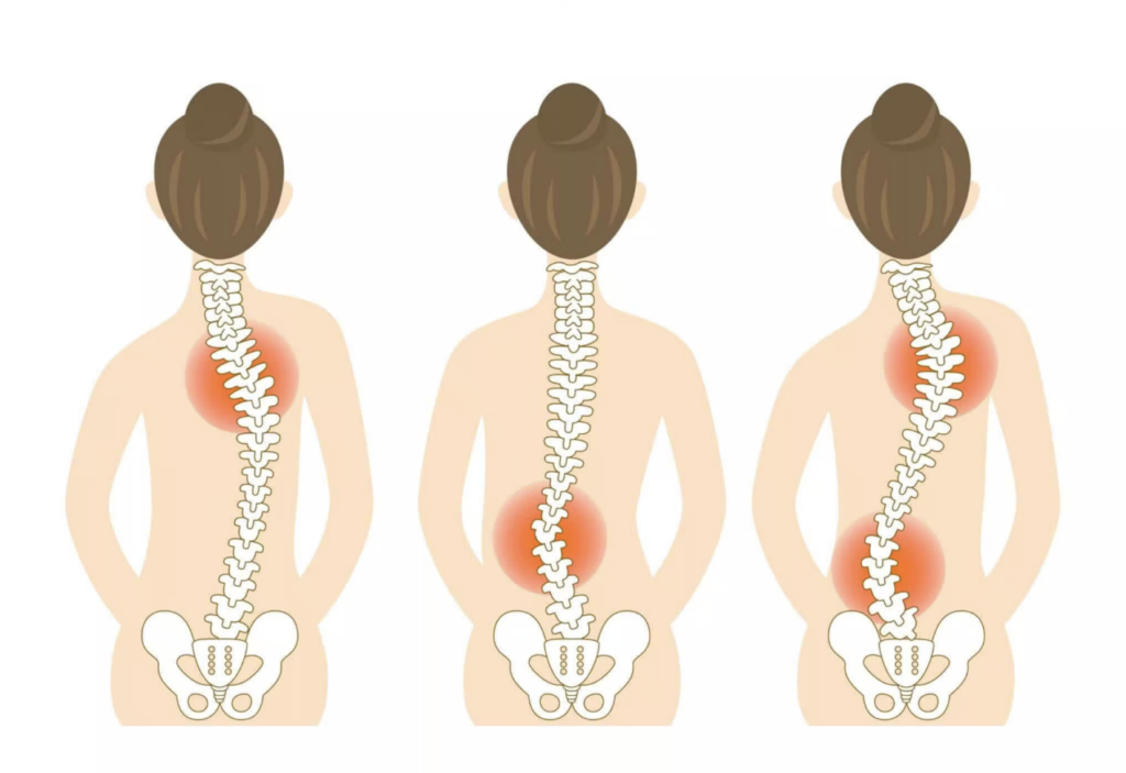 scoliosis cliparts