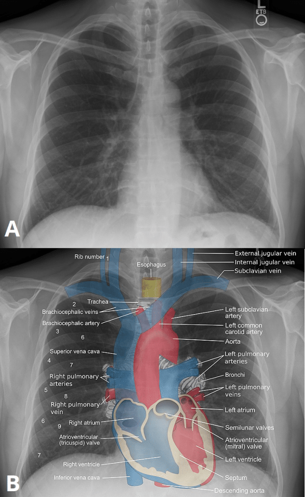 Plain Film X Ray - Principles - Interpretation - TeachMeAnatomy