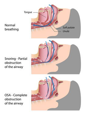 what is snoring and what is the best treatment