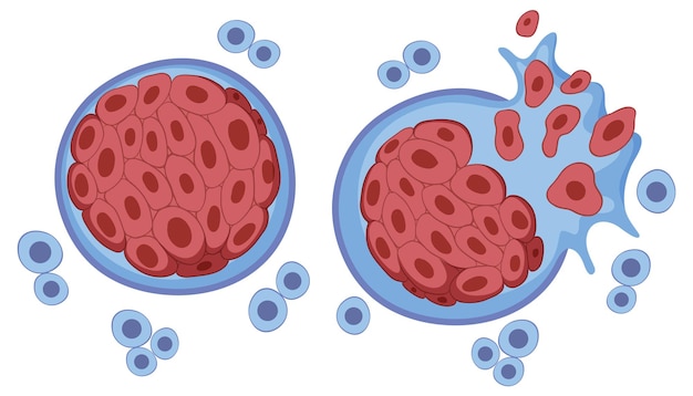 Tumor-Vektoren und -Illustrationen zum kostenlosen Download | clipart library