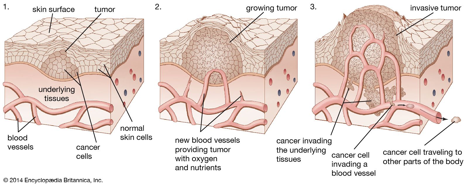 Tumour | Causes, Diagnosis &amp; Treatment | Britannica