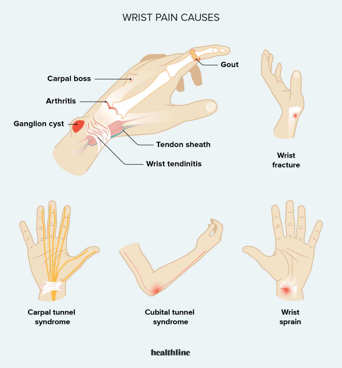 Wrist Pain: Causes, Symptoms, Treatments, and Diagnosis