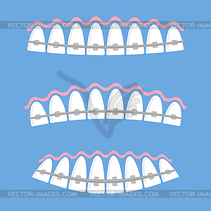 Smiling Mouth And Braces Icon On Black And White Vector 