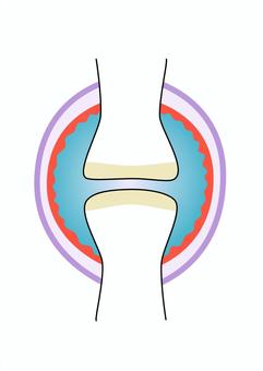 arthritis clipart
