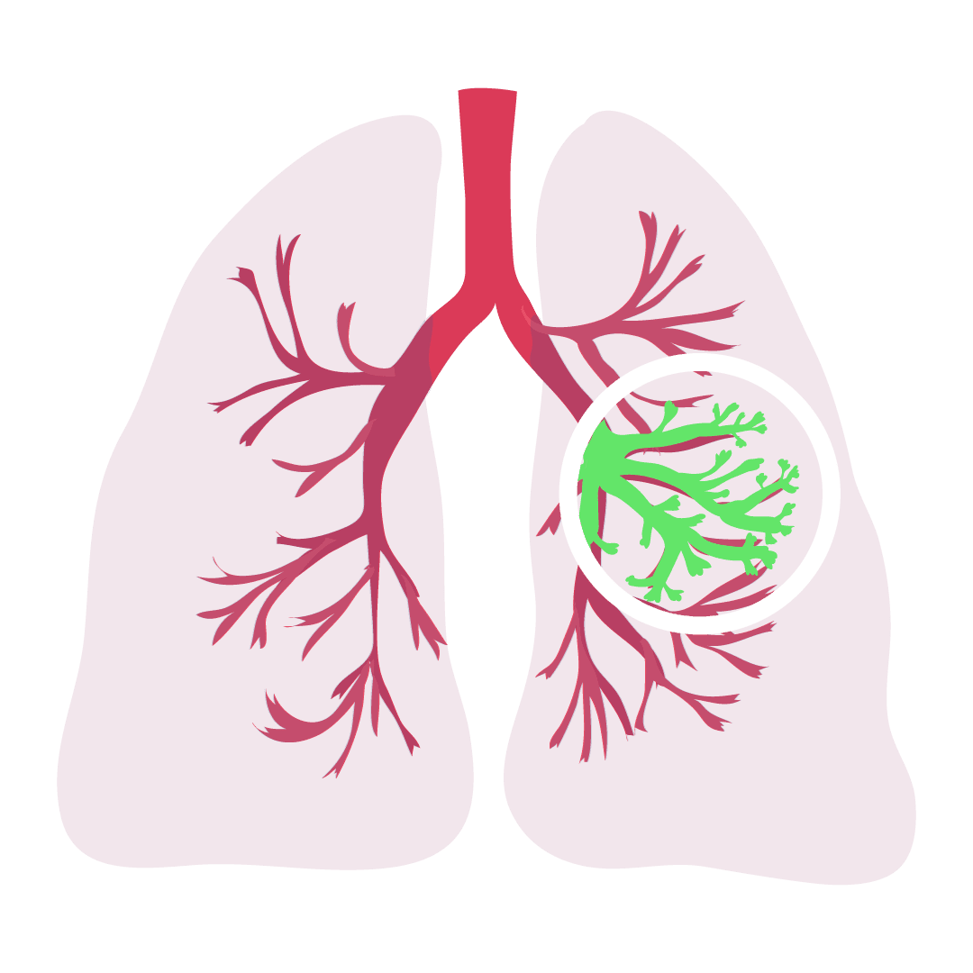 cystic fibrosis clipart
