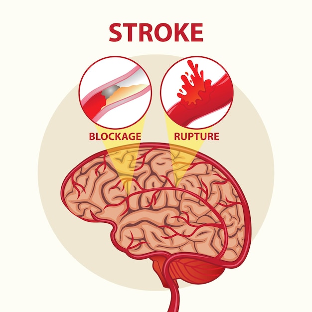 12 Human Brain Stroke Illustration