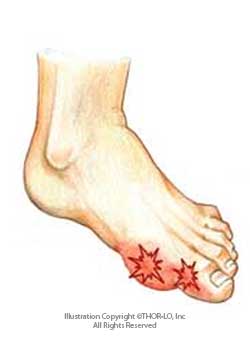 Medical illustration showing two red, star-shaped plantar warts on the sole of a human foot near the toes.
