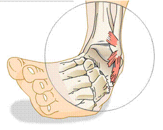 Free Sprain Cliparts, Download Free Sprain Cliparts png images, Free ...