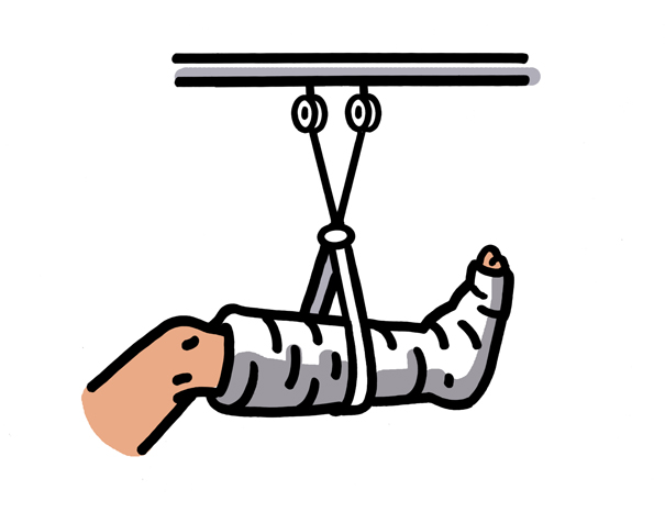 Illustrated leg in plaster cast suspended in a traction sling for orthopedic treatment.