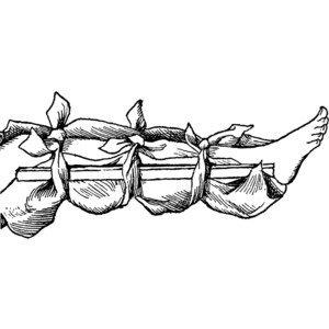 Vintage medical illustration of a leg immobilized with splints and cloth bindings for fracture treatment.