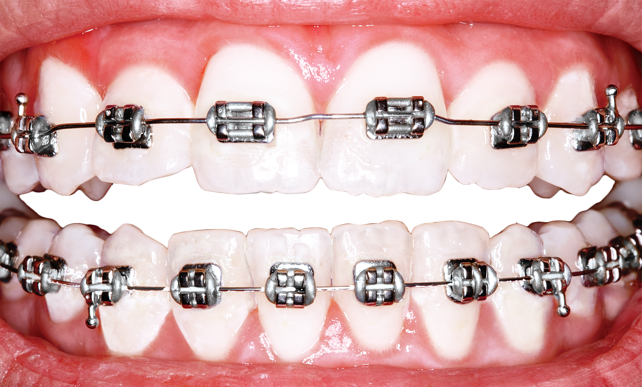 braces-not-on-teeth-clip-art-library