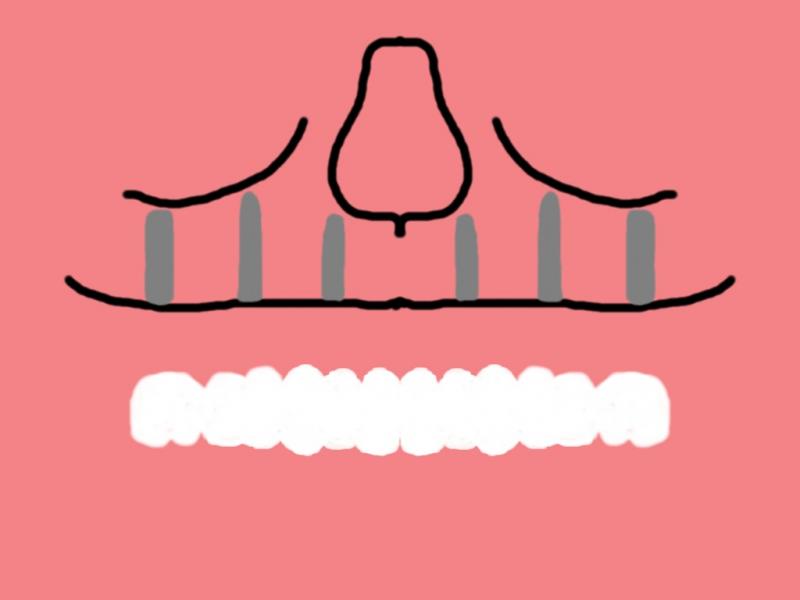 Dental Implant Bridge Diagram - How Implants Support Fixed Teeth