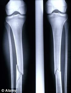 x ray broken bone clip art