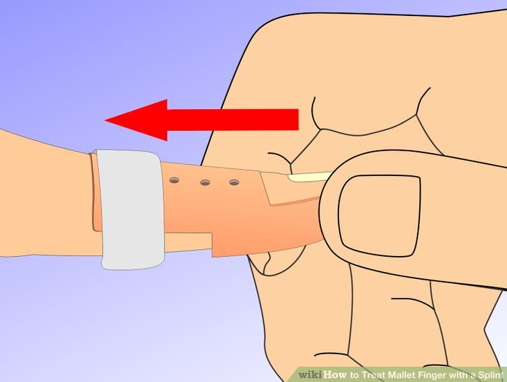 How to Treat Mallet Finger with a Splint: 10 Steps