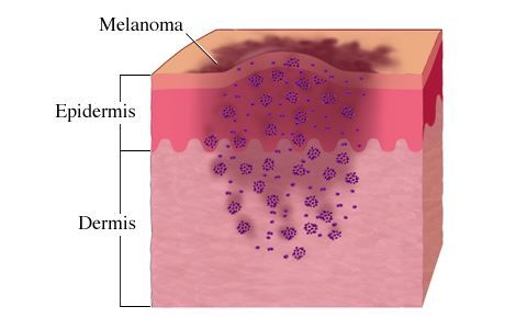 Skin Cancer Clipart