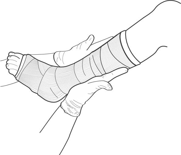 Broken Ankle Cast Clipart