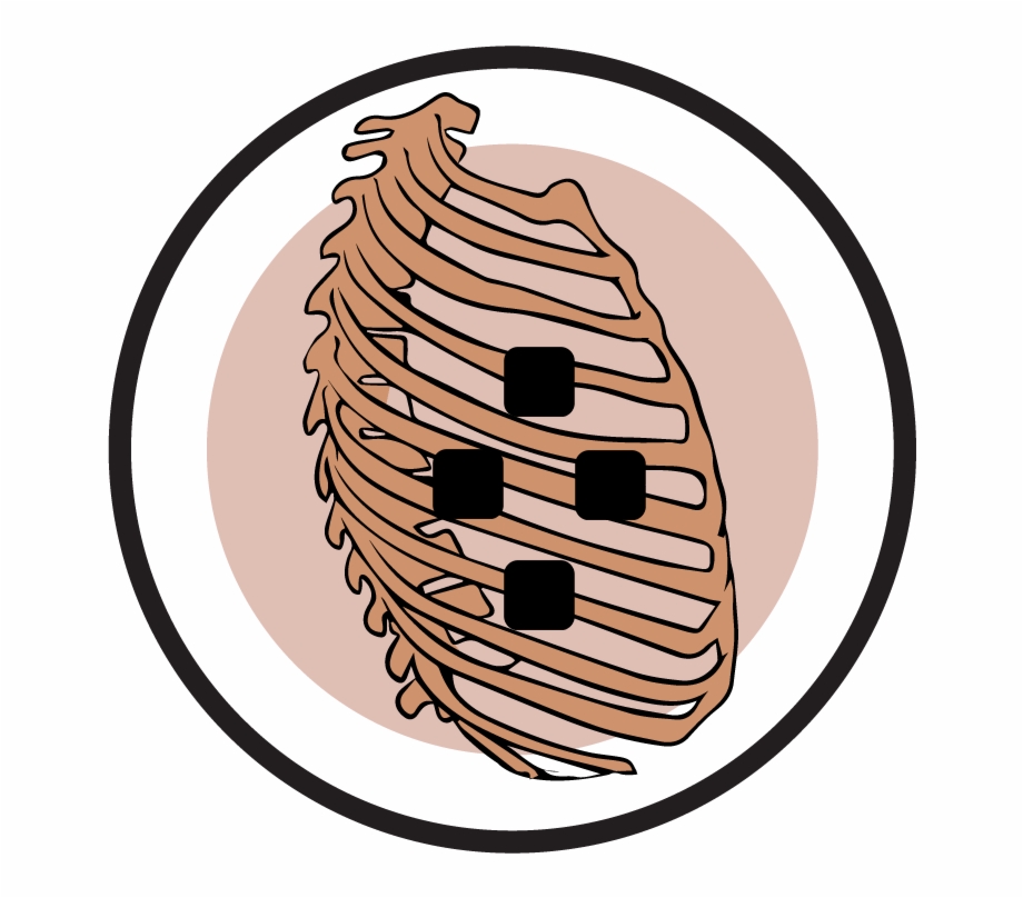 Rib Cage Electrode Pad Placement Illustration