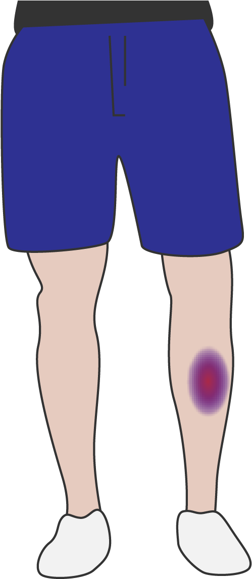 Collection Of Free Bruising Clipart Knee Download Board