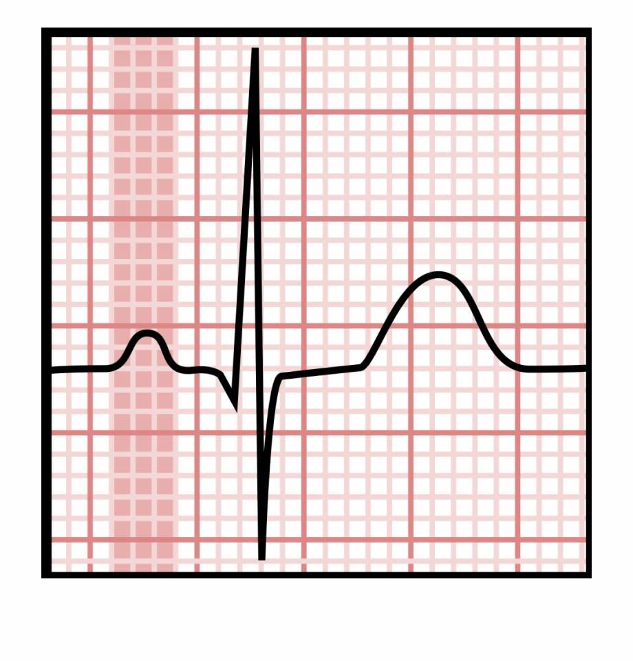 P Wave Ecg