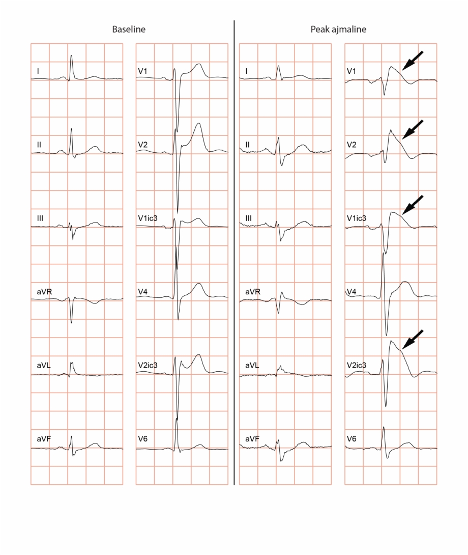 Change Of A Normal Ecg Into A Type
