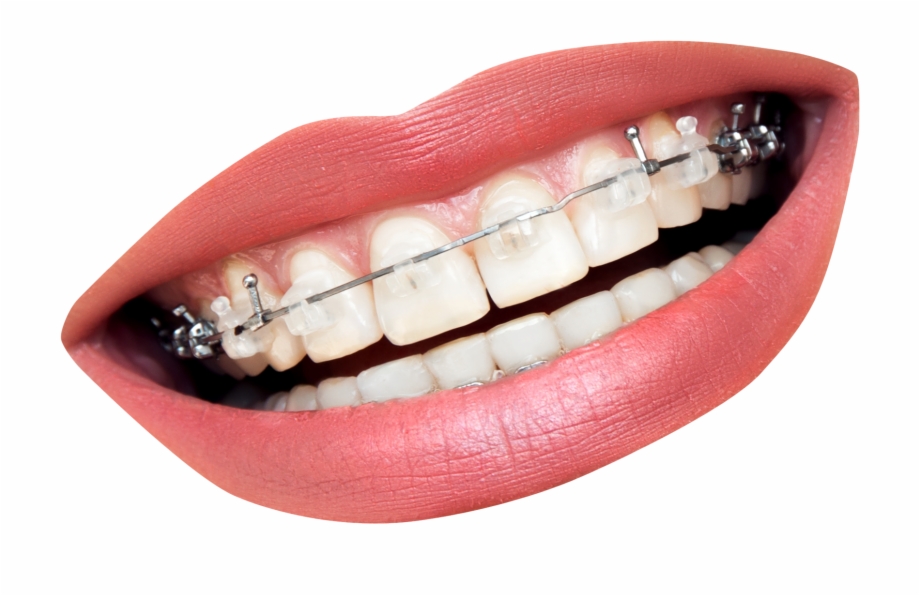 Mouth Smile Png Image Transparent Mouth With Braces