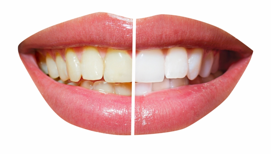 Free Icons Png Whitening Teeth Png Free
