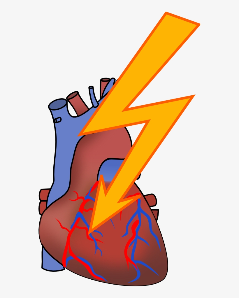 A cartoon illustration of a human heart with a large yellow lightning bolt striking it, symbolizing a heart attack or cardiac event.